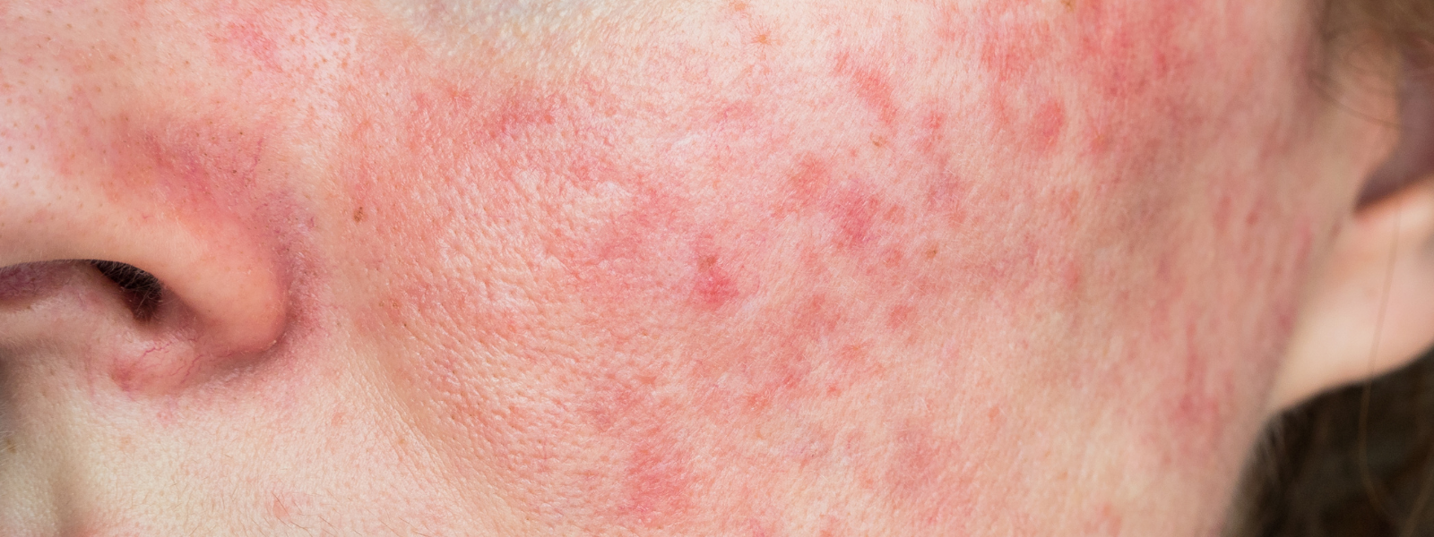 Rosacea on a woman's cheek