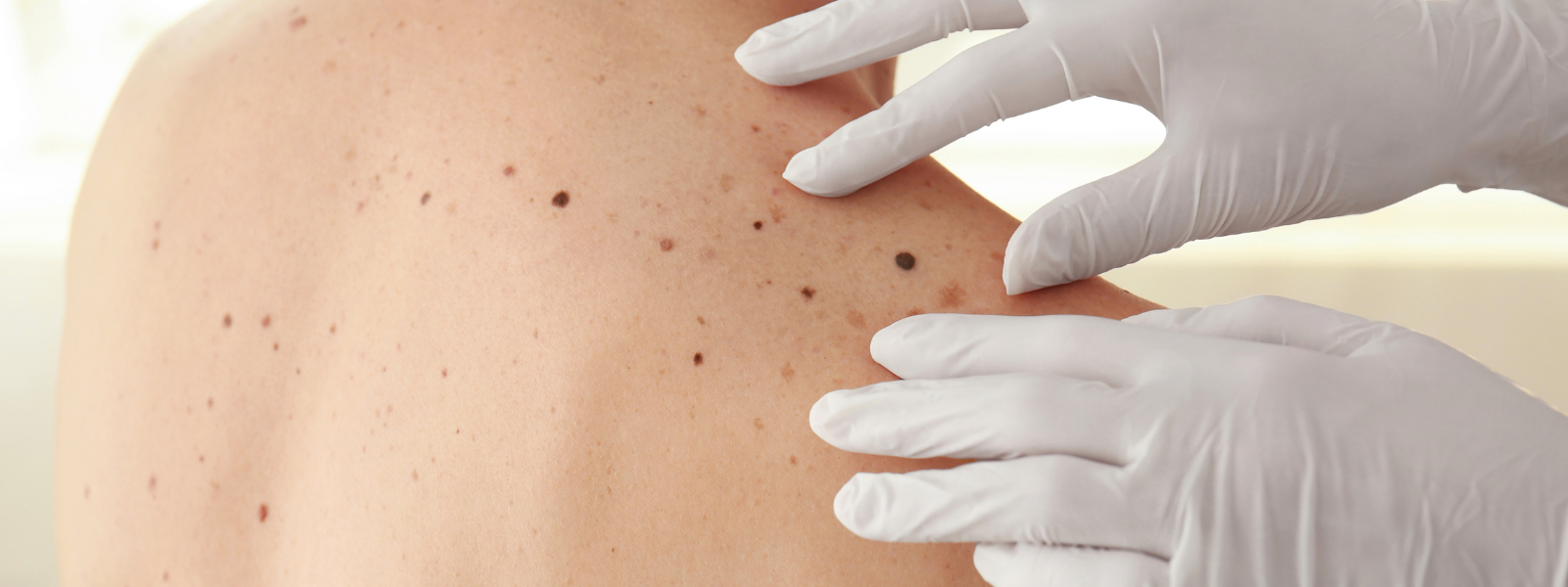 Dermatologist examines spots on a patient's back