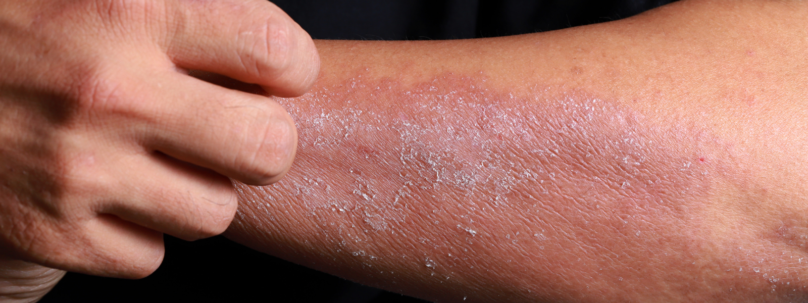 A scaly rash on an arm