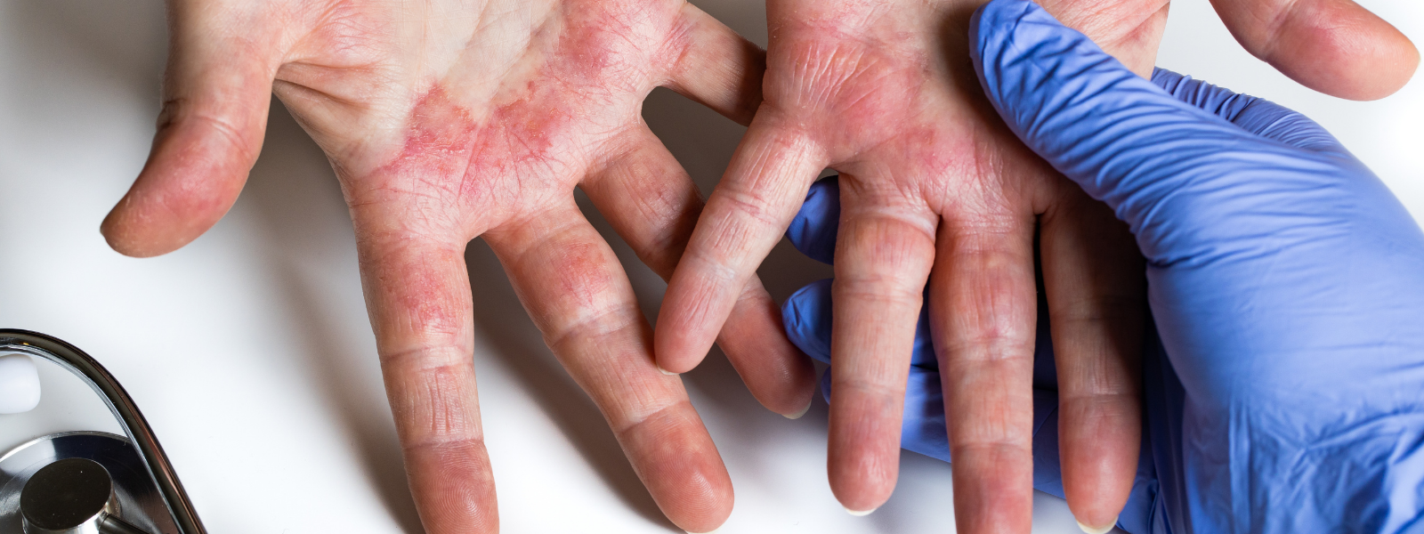 A dermatologist examines rashes on a patient's hands