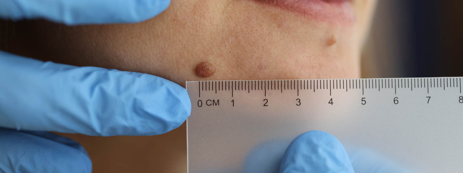 Dermatologist measures bump on patient's face